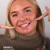 Emax veneers treatment before after results in Turkey Antalya, emax veneers turkey antalya
