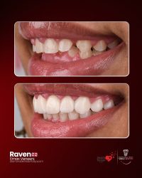 veneers prices turkey, laminate veneers turkey antalya, emax veneers turkey, emax veneers turkey antalya, emax veneers turkey prices, emax veneers prices turkey