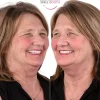 all-on-4 dental implants antalya turkey, all on 4 dental implants antalya turkey, all on 6 dental implants antalya turkey