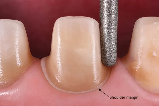 Shoulder (Step) Preparation Technique in E-max and Zirconium Crowns at Antalya Turkey