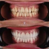 laminate veneers antalya, emax veneers, emax veneers examples, emax veneers before after, antalya emax veneers, emax veneers laminate veneers